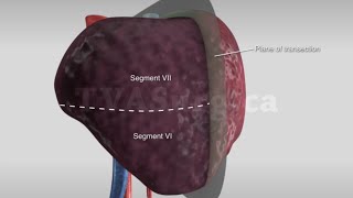 Segment VIVII resection [upl. by Ayikan]