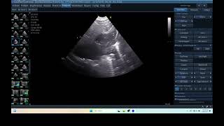 IQ 290 TFAST LUNG MASS ULTRASOUND ICP CPP ECHOPAC ANALYSIS 00 [upl. by Mozelle]