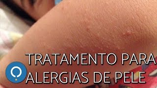 Tratamento natural para ALERGIAS DA PELE [upl. by Amsab]