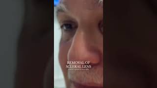 Removing Scleral Lenses [upl. by Simeon]