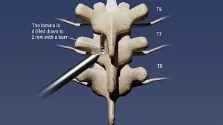 Thoracic laminectomy procedure with removal of ossified ligamentum flavum [upl. by Atekihc]