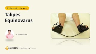 Talipes Equinovarus  Orthopedics Video Lectures  Medical Student  VLearning™ [upl. by Bebe]