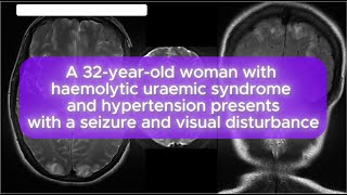 Case 123 A 32yearold woman with haemolytic uraemic syndrome and hypertension [upl. by Westphal]