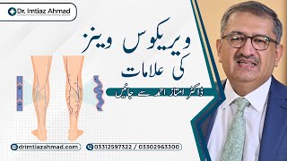 Causes of Varicose Veins  Dr Imtiaz Ahmad [upl. by Red]