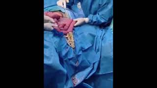 Trigger Warning Ascaris Lubricoides Intestinal Worms Parasite Removal Surgery [upl. by Lapointe]