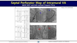 231202 Intramyocardial Map of Septal Perforators for LV Summit VA 박희남 교수 Hui Nam Pak [upl. by Carilla]