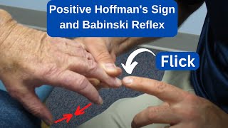 Positive Hoffmans Sign and Babinski Reflex in an MS Patient [upl. by Pik]