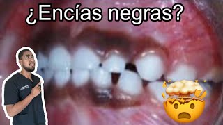 Que son esas manchas en las encías   Melanosis gingival [upl. by Kcirdnek330]