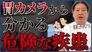 胃カメラでわかる5つの症状！鼻から検査！知っておくべき早期診断の大切さ！ [upl. by Currier]