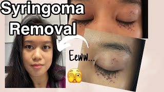 My Syringoma Removal process with pictures [upl. by Lili733]