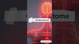 Glioblastoma or GBM  the aggressive brain tumor glioblastoma gbm brain tumores cancer [upl. by Iey362]