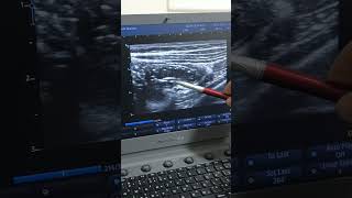 Ascaris lumrbricoid by ultrasound ثالث حاله إسكارس بالسونار [upl. by Atews415]