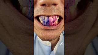 Chewing Disclosing Tablets dentist asmr shorts [upl. by Billi]