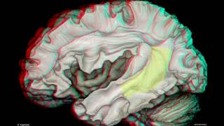 Fiber Pathways of the Cerebrum 3D Anaglyph [upl. by Snevets]