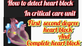 Heart block Atrioventricular block  AV block  ECG of heart block  mobitz type 1 and 2 [upl. by Emarie554]