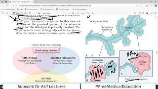 Chp13 Robbins Patho  Lung Pathology  EMPHYSEMA  Obstructive Lung Diseases [upl. by Ileray112]