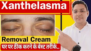 Xanthelasma Removal Cream  How to treat Xanthelasma home Remedies [upl. by Airdnola]