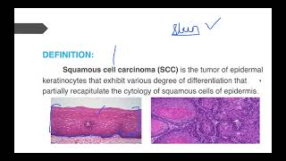 Squamous Cell Carcinoma [upl. by Adav]