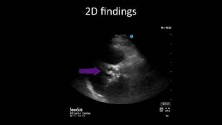 PointofCare Echo Aortic Stenosis vs Sclerosis [upl. by Nueoras107]