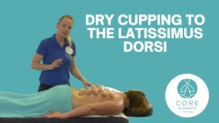 Clinical Dry Cupping to the back  Latissimus Dorsi [upl. by Rachelle]