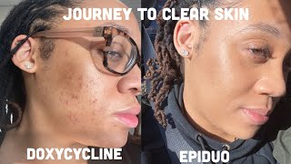 Journey to clear skin using Doxycycline and Epiduo adapalenebenzoyl peroxide [upl. by Nahtanaoj351]