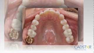 CEREC emax Proximal Contacts [upl. by Suirtemed658]