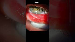 Guess the condition with picture eyecareoptom5506 shorts short eye conjunctivitis [upl. by Aliek]