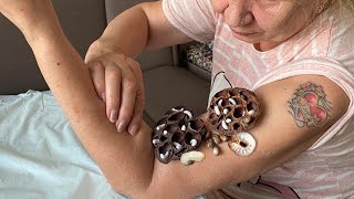 Removing ticks  saving a womans hand from a nest with many trypophobia holes [upl. by Renba]