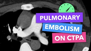 Pulmonary embolism on CTPA  Radiopaedias Emergency Radiology Course [upl. by Eleinad126]