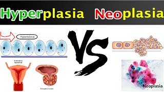 Neoplasia Vs Hyperplasia  Clear Comparison [upl. by Ecirtnahs493]