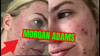 MORGAN ADAMS burns FACE OFF SUES hailey bieber rhode skin [upl. by Holihs811]