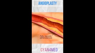 Coronary angioplasty Femoral Access [upl. by Sinnal189]