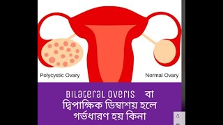 Bilateral polycystic Overies বা দ্বিপাক্ষক ডিম্বাশয় হলে গর্ভধারণ হয় কি না [upl. by Rosalba270]