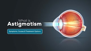 What is Astigmatism Symptoms Causes amp Treatment Options [upl. by Cohn]