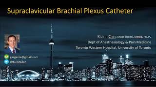 UltrasoundGuided Supraclavicular Brachial Plexus Catheter Insertion [upl. by Huxley]