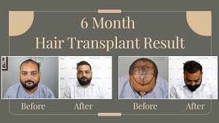 6 months Hair Transplant results in Norwood Grade 6 Male Pattern Baldness Thin Donor [upl. by Callahan]