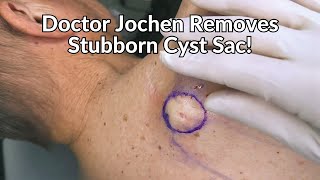 Entire Cyst Sac Removed from Patients Back  CONTOUR DERMATOLOGY [upl. by Akenahs]