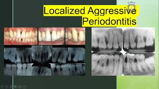 LOCALIZED AGGRESSIVE PERIODONTITIS [upl. by Anesuza705]