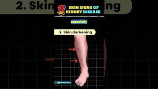 5 Weird Skin Signs of Kidney Disease  Chronic Kidney Disease shortsfeed kidney kidneydisease [upl. by Heisel486]