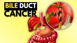 BIle Duct Cancer Cholangiocarcinoma Causes Signs and Symptoms Diagnosis and Treatment [upl. by Pris]