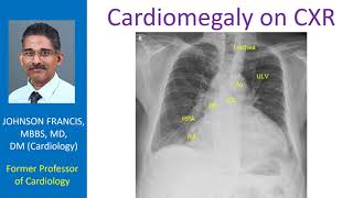 Cardiomegaly on CXR [upl. by Spiegel288]