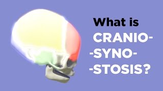 What is Craniosynostosis [upl. by Anirahc243]