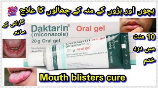 Mouth ulcer  Mouth sores Oral Fungal infection treatment  Daktarin oral gel How to use Review [upl. by Carrelli]