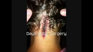 My Chiari Malformation story [upl. by Ainegul]