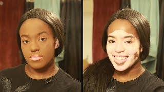 I Won’t Hide My Vitiligo With Makeup  SHAKE MY BEAUTY [upl. by Granniah]