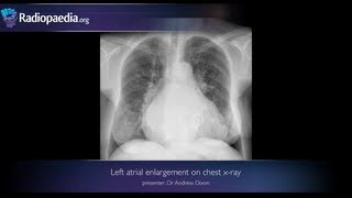 Left atrial enlargement on chest xray  radiology video tutorial [upl. by Aracot226]