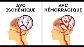 AVC accident vasculaire cérébrale  iade study [upl. by Otrebor]