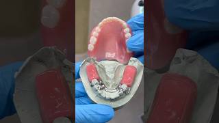 Denture and Metal Bite Block lsk121shorts dentist teeth [upl. by Gladi861]