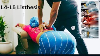 HOW TO TREAT BACKPAINL4L5 Anterolisthesis Best Chiropractor in India Immediate relief [upl. by Kovacs994]