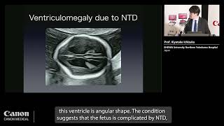 ISUOG 2023 – Prof Kiyotake Ichizuka  2nd trimester anomaly scan using the new Technology [upl. by Naanac148]